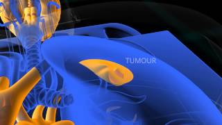 PET Scan animation [upl. by Aleciram]