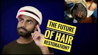 Laser Hair Therapy For Balding amp Thinning Hair  Rogaine vs iRestore [upl. by Noraa]