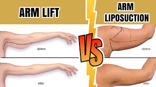 Arm Lift or Liposuction  Difference between arm lift and arm liposuction [upl. by Adlai]