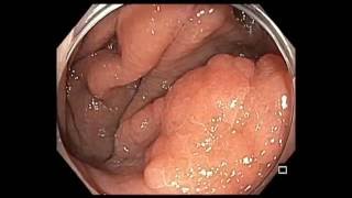 Colonoscopy Cecum Flat Lesion  EMR  Technically Challenging Area [upl. by Liss]