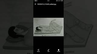 Lithotomy position [upl. by Darwin]