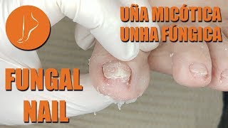 Fungal nail Podología Integral [upl. by Hiro945]