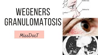 GRANULOMATOSIS WITH POLYANGITIS Wegeners Granulomatosis [upl. by Nonnahs]