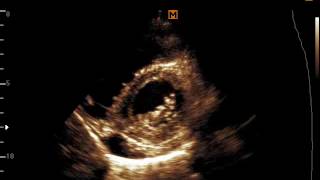 Rheumatic heart disease ECHO PSAX Mitral Valve level [upl. by Close]