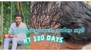 Hair transplantation after 130 days  ഹെയർ ലൈൻ റെഡി ആയിതുടങ്ങി  safvan pullara [upl. by Navy]