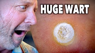 HUGE DECAYING WART Frozen With Liquid Nitrogen  Dr Paul [upl. by Harlamert]