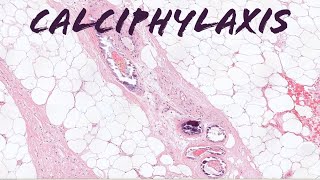 Calciphylaxis deadly complication of chronic kidney disease renal failure pathology dermpath [upl. by Alejandro]