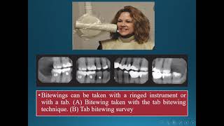 Intraoral radiographic techniques [upl. by Naik]