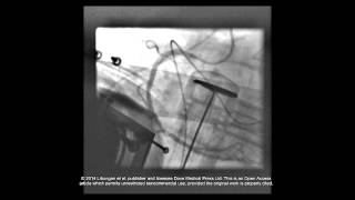 Case report PCI during cardiac arrest  Supplementary video 2 57953 [upl. by Pronty]