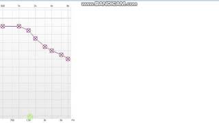 Presbycusis Hearing Loss Audiogram [upl. by Ettenoj292]