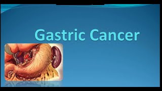 Gastric Cancer Surgery Lecture Symptoms  Diagnosis and Treatment [upl. by Nalym]