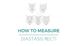 How to measure Diastasis Recti [upl. by Elamaj925]