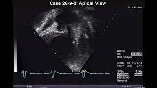 P594 Clip 269 Eisenmenger Syndrome [upl. by Jose113]