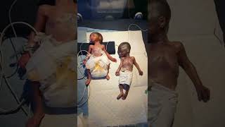 Twins  Twin Pregnancy  Babies in the womb  Multiple Pregnancy shortsfeed twins baby fyp [upl. by Mide]