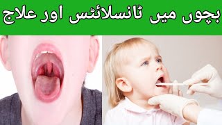 Tonsillitis in children Causes Symptoms and TreatmentGalay ka infection [upl. by Teik246]