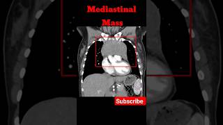 Mediastinal Mass  CECT Chest shorts radiology tumores education [upl. by Iniretake766]