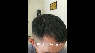 Day 30 Of Minoxidil Treatment  Without Finasteride [upl. by Erhart]