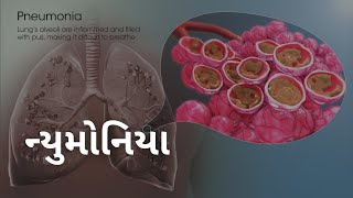 Family Doctor 1353  ન્યુમોનિયા  VR LIVE [upl. by Paulson131]