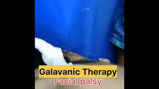 Facial nerve palsy [upl. by Drice468]