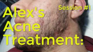 Alexs Acne Treatment Session1 [upl. by Rizzi]