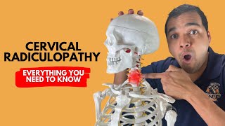 Cervical Radiculopathy Everything You Need To Know To Get Better Without Surgery [upl. by Bjork]