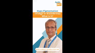 What Is Hypopigmentation  Dr Ravichandran G [upl. by Weinstock]