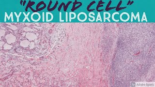 quotRound cellquot High Grade Myxoid Liposarcoma [upl. by Scarlett]