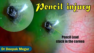 Pencil Injury to the eye  Pencil Lead Stuck inside Tips to remove the FB  Dr Deepak Megur [upl. by Purvis]