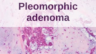 Pleomorphic Adenoma of Salivary Gland [upl. by Stilu263]