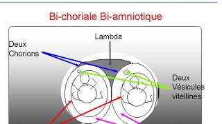 GYNECOLOGIE Grossesses multiples TDD Grossesse Gemellaire [upl. by Drannek409]