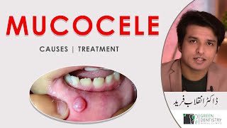 What is Mucocele  Causes  Treatment  Urdu  Hindi  Dr Inqalab Fareed [upl. by Roselani]