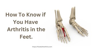 How To Know If You Have Arthritis in Your Feet [upl. by Emia]