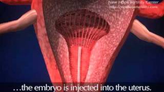 Embryo Transfer [upl. by Ahseyn]