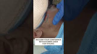 Excimer Laser Treatment for Vitiligo at Reincarnation Skin Clinic [upl. by Howarth]