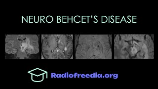 Neuro Behcets Disease Imaging Walkthrough  Radiofreediaorg [upl. by Derej]