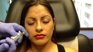 Botox amp Juvederm Voluma Injections for Young Women [upl. by Ennagroeg329]