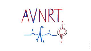 Atrioventricular Nodal Reentrant Tachycardia AVNRT SVT ecgtutorial cardiology AVRT Arrhythmia [upl. by Caddric90]