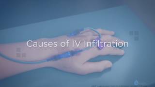 Causes of IV Infiltration  Training Video [upl. by Adlen832]