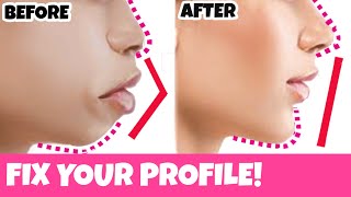 Get a Perfect Profile like BTS’s Kim Taehyung Fix Protruding Mouth Overbite Small Chin Nose [upl. by Kcirdes]