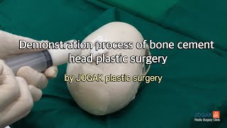 Demonstration process of bone cement head plastic surgery [upl. by Gnuhp]