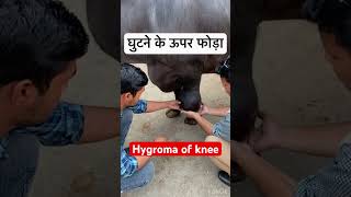 Hygroma of knee l dr Umar khan [upl. by Nayve]