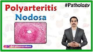 Polyarteritis nodosa  Definition Epidemiology Pathology Clinical features Diagnosis Treatment [upl. by Salot]