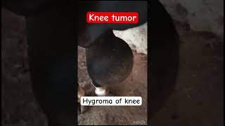 Hygroma of knee l dr Umar khan [upl. by Bahe342]