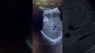 Hemangioma Ultrasound  Liver Mass sonography  ARDMS  Radiology Sonographer [upl. by Gwendolyn646]