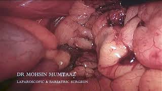 Sleeve Gastrectomy  Performed By Dr Mohsin Mumtaaz  Bariatric Surgery [upl. by Iong403]