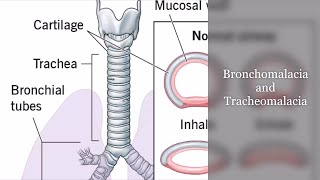 Bronchomalacia and Tracheomalacia [upl. by Sexela]