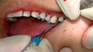 Gracey Instrumentation During Periodontal Therapy [upl. by Arjan]