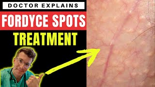 5 Best Ways to Remove Fordyce Spots Naturally at Home YouTube [upl. by Hinman]