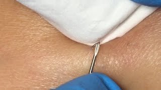 Ingrown Hairs Extraction  16 minutes [upl. by Ikcin141]