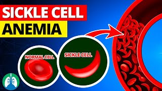 Sickle Cell Anemia  Quick Explainer Video [upl. by Alidia]